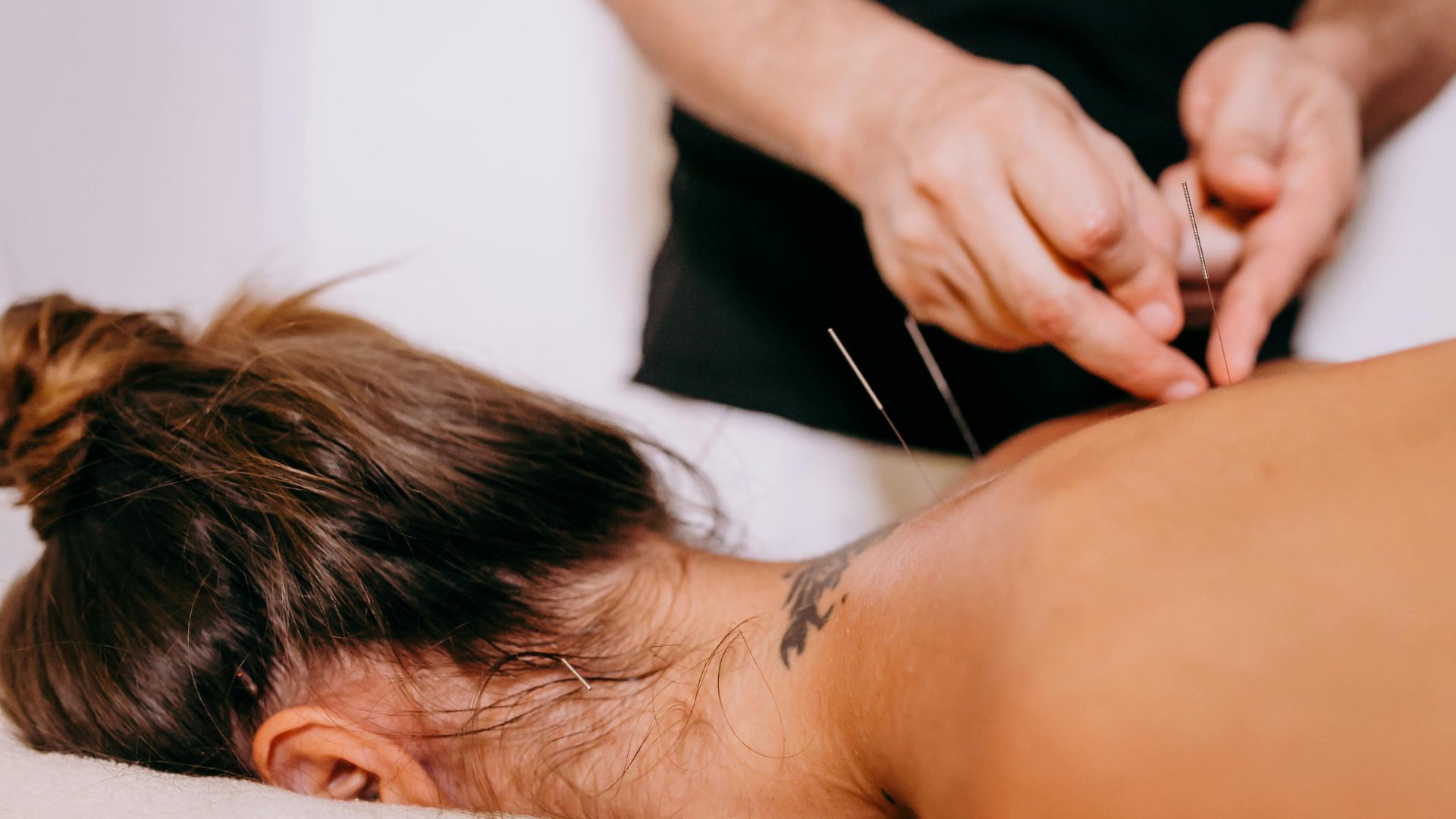 acupuncture for allergies